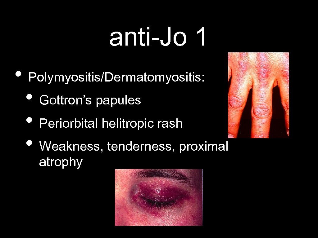 anti-Jo 1 • Polymyositis/Dermatomyositis: • Gottron’s papules • Periorbital helitropic rash • Weakness, tenderness,