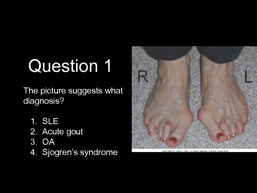 Question 1 The picture suggests what diagnosis? 1. 2. 3. 4. SLE Acute gout