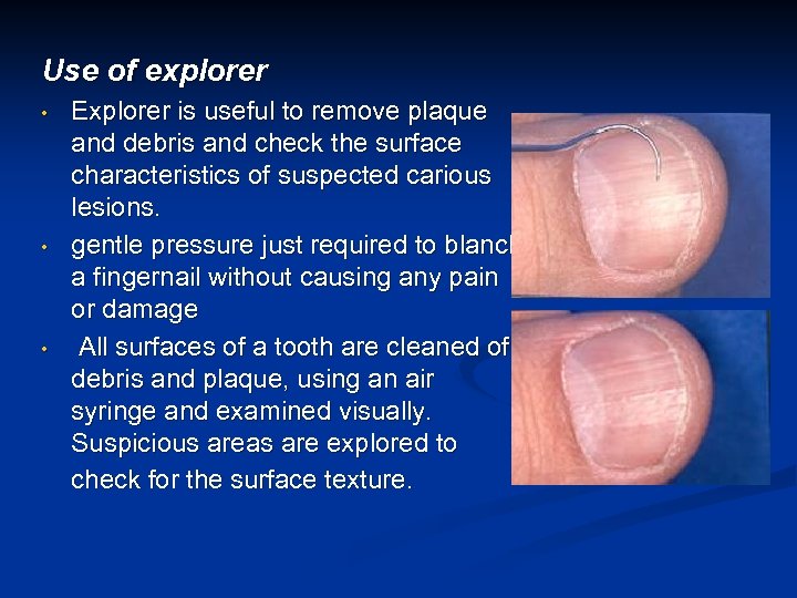 Use of explorer • • • Explorer is useful to remove plaque and debris