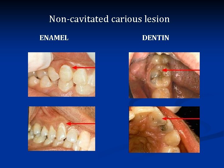 Non-cavitated carious lesion ENAMEL DENTIN 