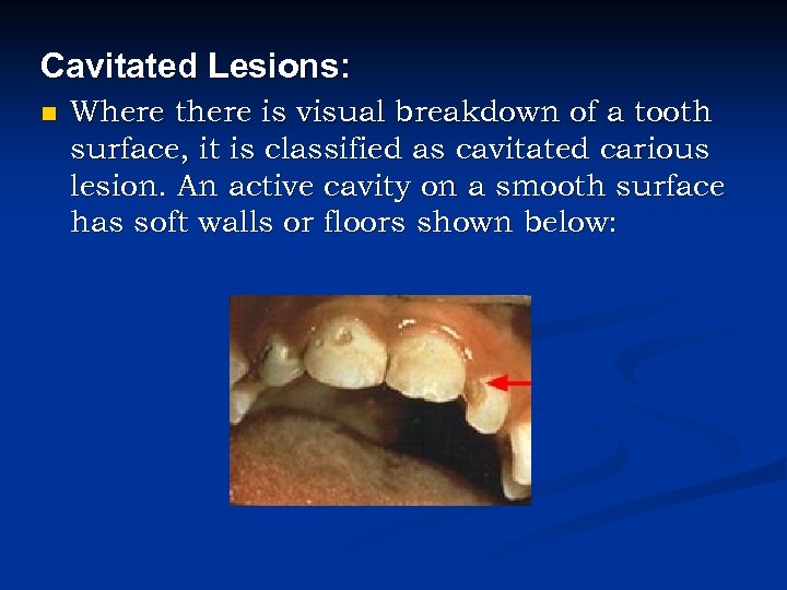 Cavitated Lesions: n Where there is visual breakdown of a tooth surface, it is