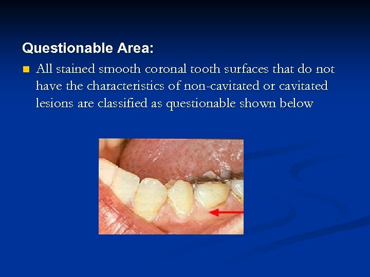 Questionable Area: n All stained smooth coronal tooth surfaces that do not have the