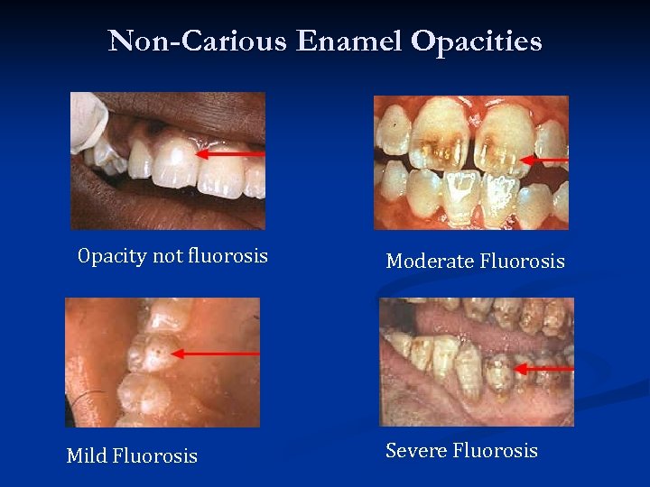 Non-Carious Enamel Opacities Opacity not fluorosis Mild Fluorosis Moderate Fluorosis Severe Fluorosis 