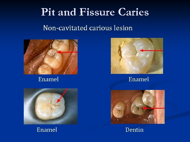 Pit and Fissure Caries Non-cavitated carious lesion Enamel Dentin 