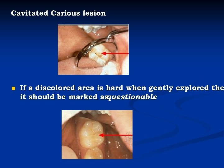 Cavitated Carious lesion n If a discolored area is hard when gently explored the