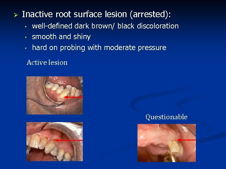 Ø Inactive root surface lesion (arrested): • • • well-defined dark brown/ black discoloration