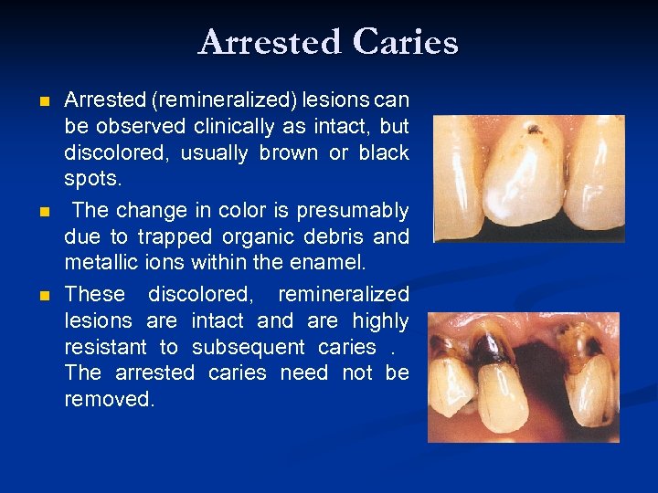 Arrested Caries n n n Arrested (remineralized) lesions can be observed clinically as intact,