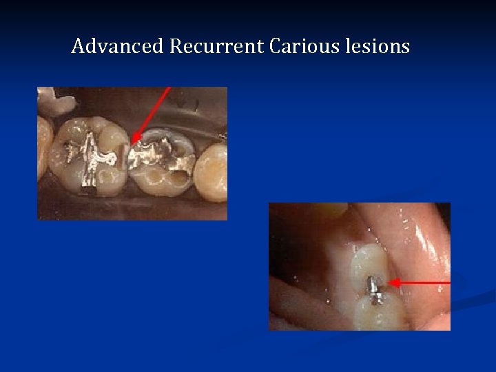 Advanced Recurrent Carious lesions 