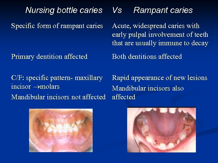 Nursing bottle caries Vs Rampant caries Specific form of rampant caries Acute, widespread caries