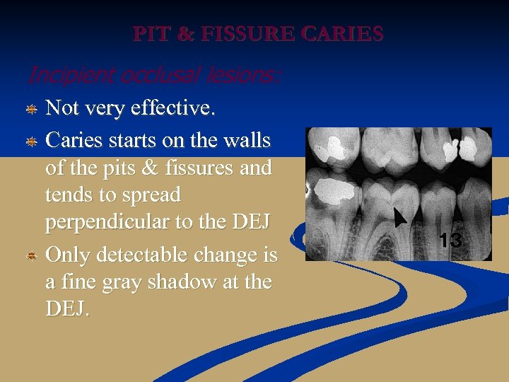 PIT & FISSURE CARIES Incipient occlusal lesions: Not very effective. Caries starts on the