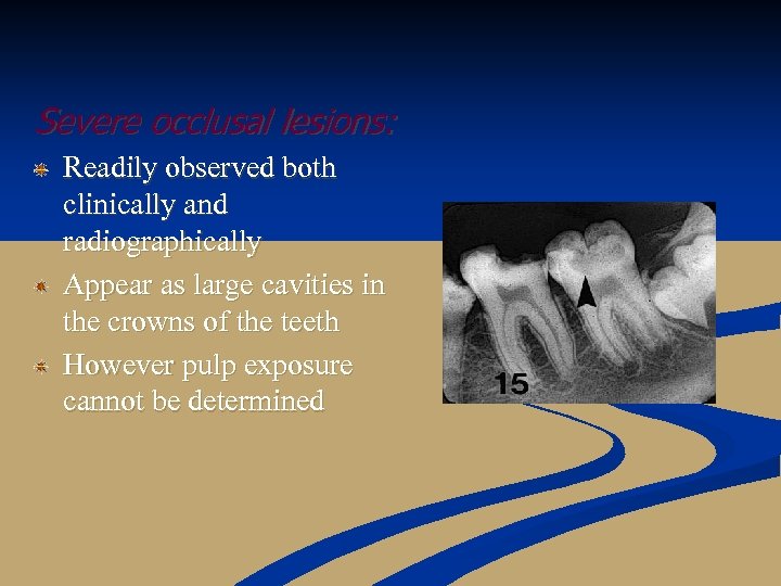 Severe occlusal lesions: Readily observed both clinically and radiographically Appear as large cavities in