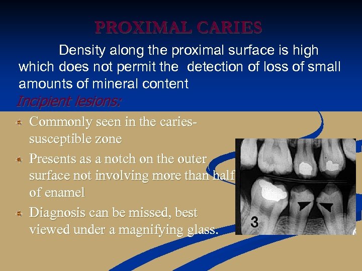 PROXIMAL CARIES Density along the proximal surface is high which does not permit the