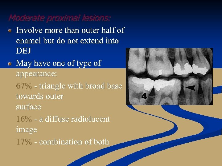 Moderate proximal lesions: Involve more than outer half of enamel but do not extend