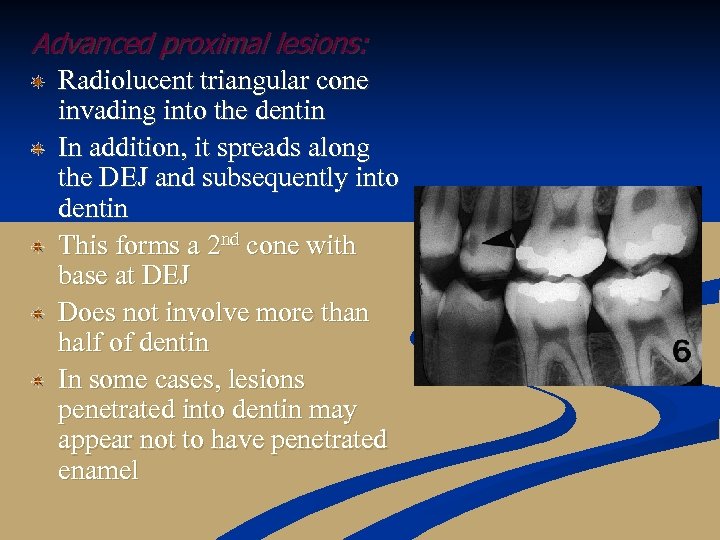 Advanced proximal lesions: Radiolucent triangular cone invading into the dentin In addition, it spreads