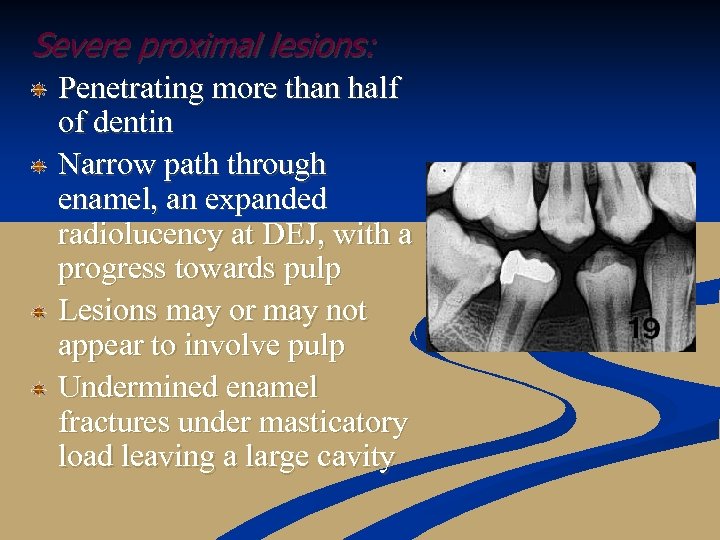 Severe proximal lesions: Penetrating more than half of dentin Narrow path through enamel, an