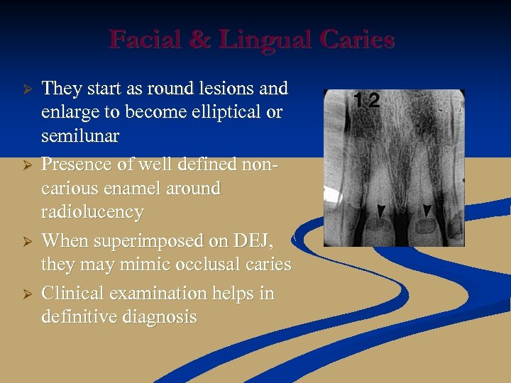 Facial & Lingual Caries Ø Ø They start as round lesions and enlarge to