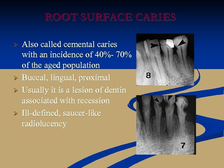 ROOT SURFACE CARIES Ø Ø Also called cemental caries with an incidence of 40%-