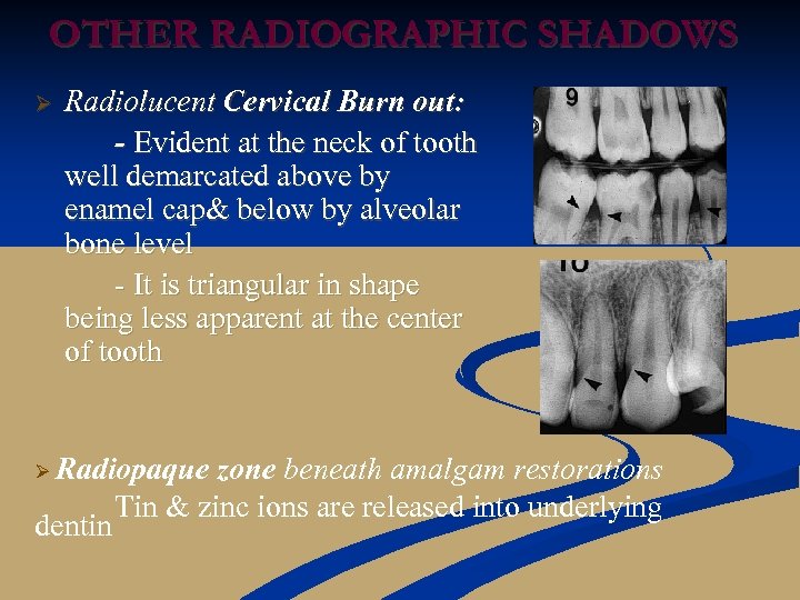 OTHER RADIOGRAPHIC SHADOWS Ø Radiolucent Cervical Burn out: - Evident at the neck of