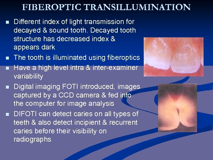 FIBEROPTIC TRANSILLUMINATION n n n Different index of light transmission for decayed & sound