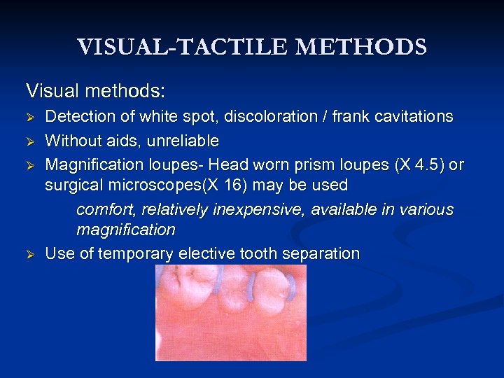 VISUAL-TACTILE METHODS Visual methods: Ø Ø Detection of white spot, discoloration / frank cavitations