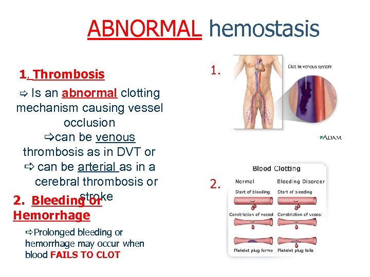 ABNORMAL hemostasis 1. Thrombosis Is an abnormal clotting mechanism causing vessel occlusion can be