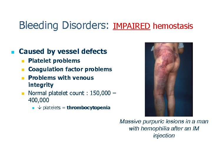 Bleeding Disorders: IMPAIRED hemostasis n Caused by vessel defects n n Platelet problems Coagulation