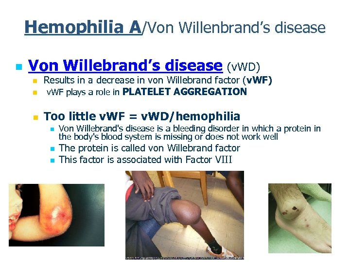 Hemophilia A/Von Willenbrand’s disease n Von Willebrand’s disease (v. WD) n Results in a