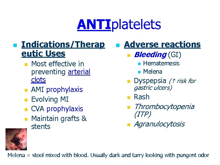 ANTIplatelets n Indications/Therap eutic Uses n n n Most effective in preventing arterial clots