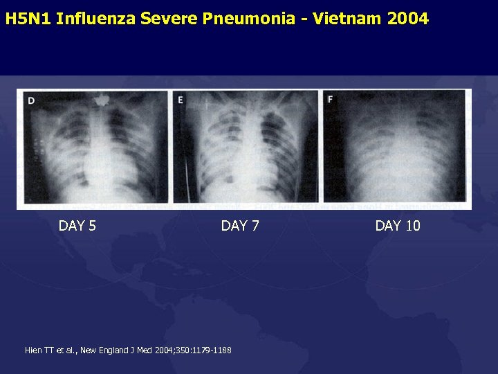 H 5 N 1 Influenza Severe Pneumonia - Vietnam 2004 DAY 5 DAY 7