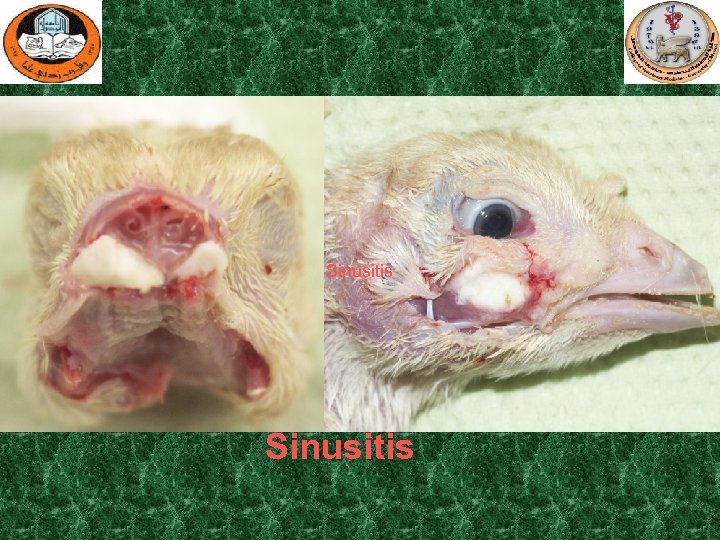 Sinusitis 