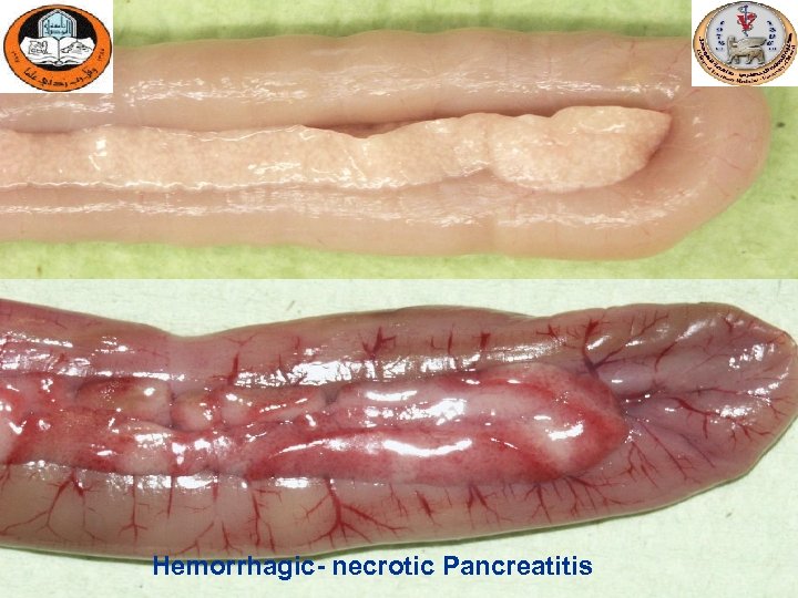 Hemorrhagic- necrotic Pancreatitis 