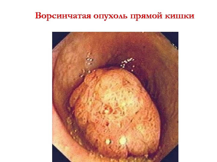 Ворсинчатая опухоль прямой кишки 