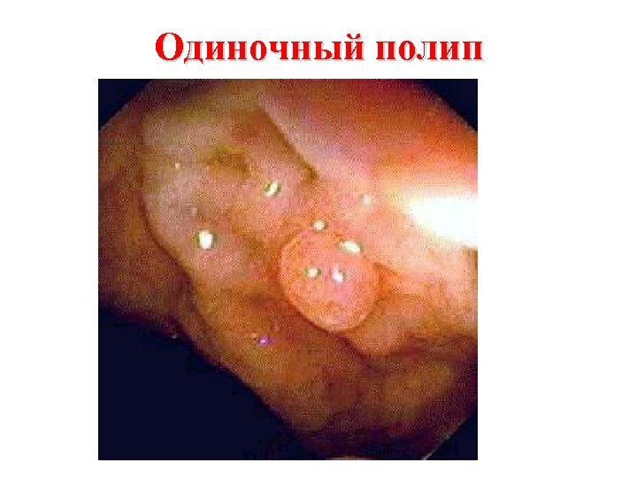 Одиночный полип 