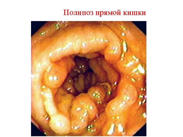 Полипоз прямой кишки 