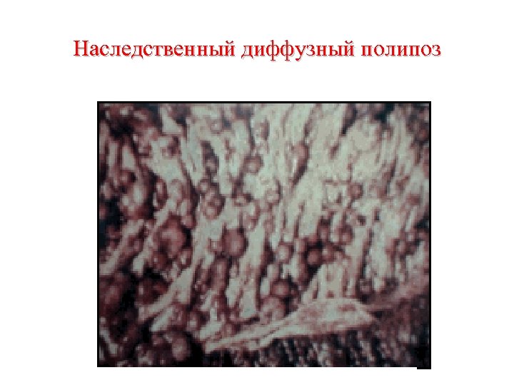 Наследственный диффузный полипоз 