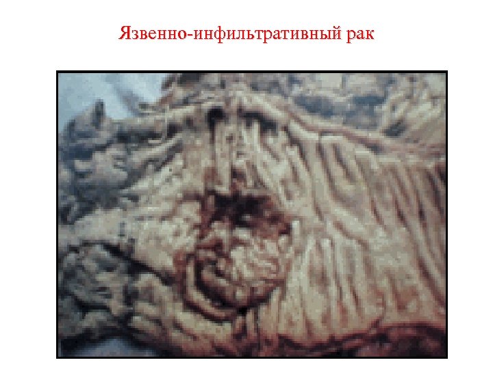 Язвенно-инфильтративный рак 