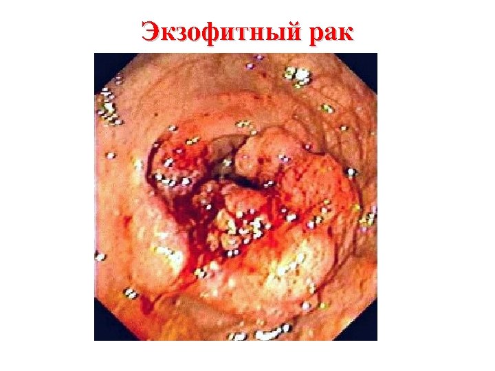 Экзофитный рак 