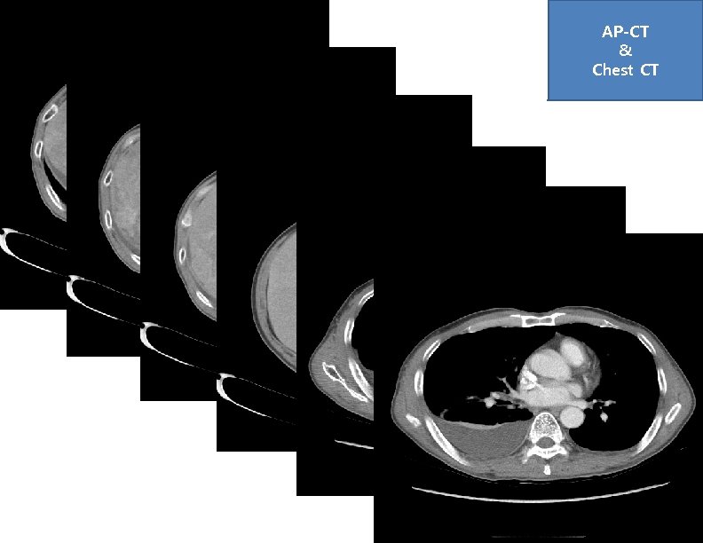 AP-CT & Chest CT 
