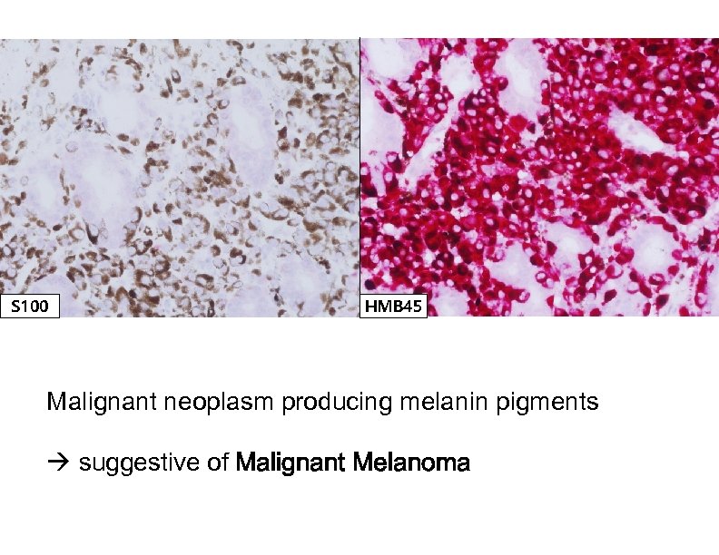 S 100 HMB 45 Malignant neoplasm producing melanin pigments suggestive of Malignant Melanoma 
