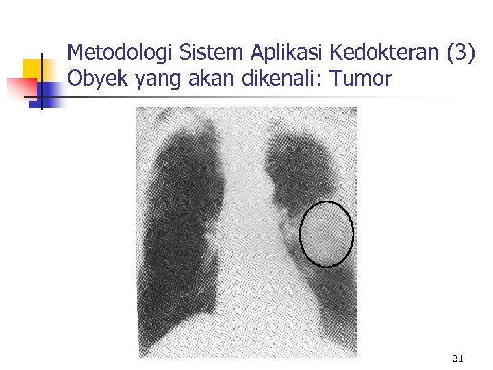 Metodologi Sistem Aplikasi Kedokteran (3) Obyek yang akan dikenali: Tumor 31 