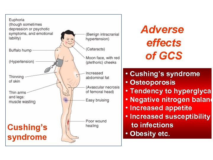 Adverse effects of GCS Cushing’s syndrome • Cushing’s syndrome • Osteoporosis • Tendency to