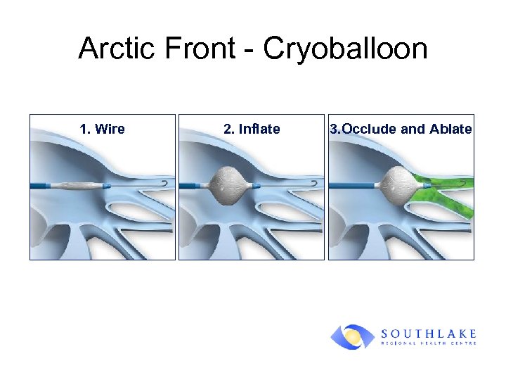 Arctic Front - Cryoballoon 1. Wire 2. Inflate 3. Occlude and Ablate 