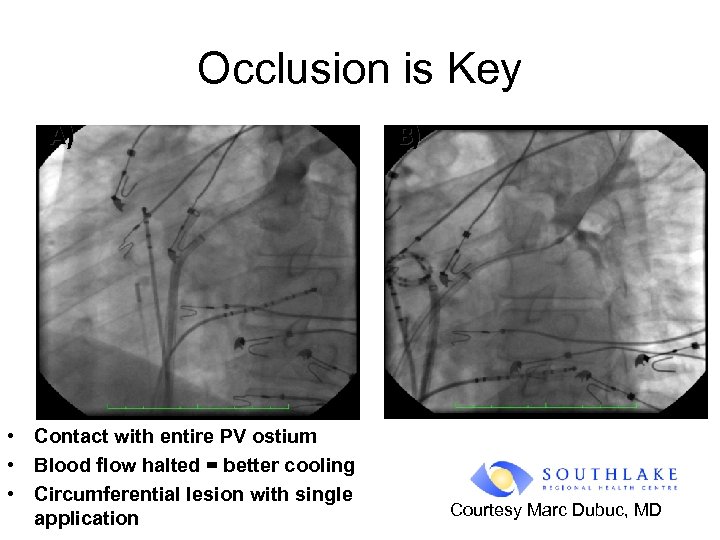 Occlusion is Key A) • Contact with entire PV ostium • Blood flow halted