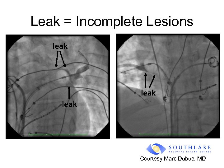 Leak = Incomplete Lesions leak Courtesy Marc Dubuc, MD 