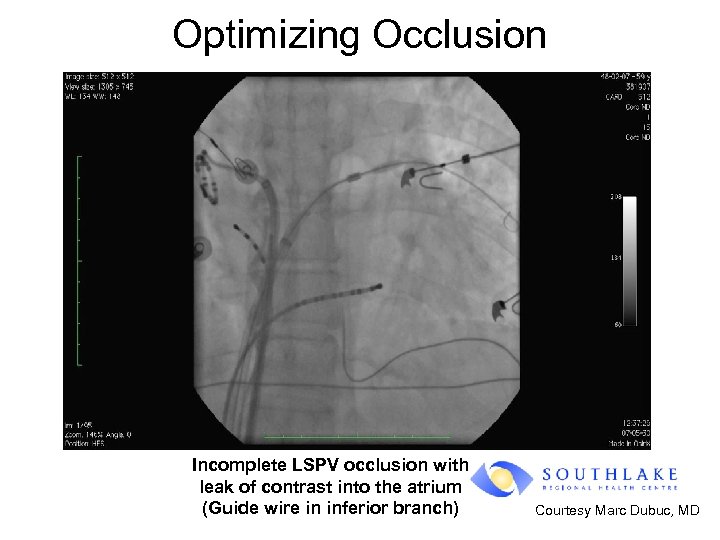 Optimizing Occlusion Incomplete LSPV occlusion with leak of contrast into the atrium (Guide wire