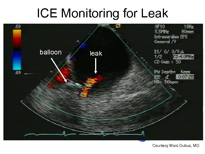 ICE Monitoring for Leak balloon leak Courtesy Marc Dubuc, MD 