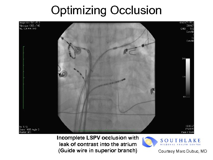 Optimizing Occlusion Incomplete LSPV occlusion with leak of contrast into the atrium (Guide wire