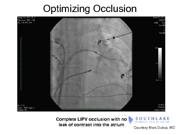 Optimizing Occlusion Complete LIPV occlusion with no leak of contrast into the atrium Courtesy