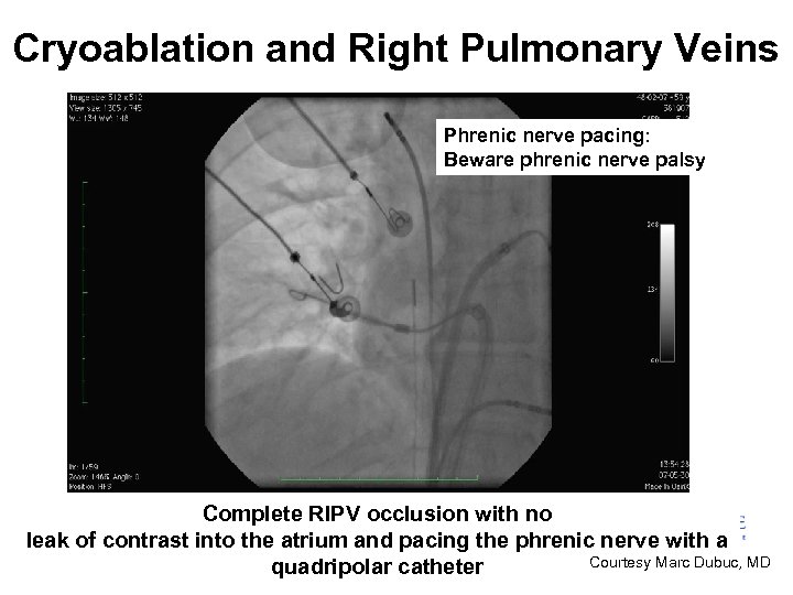 Cryoablation and Right Pulmonary Veins Phrenic nerve pacing: Beware phrenic nerve palsy Complete RIPV