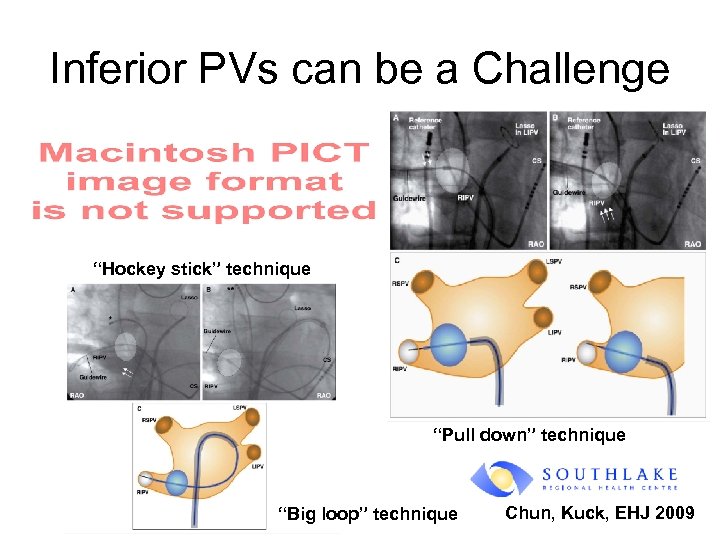 Inferior PVs can be a Challenge “Hockey stick” technique “Pull down” technique “Big loop”